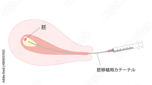 胚移植　妊娠　人工授精
