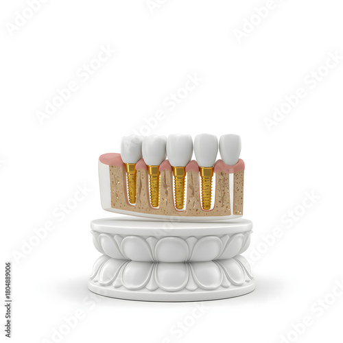 3D realistic medical illustration of dental implants in a jawbone