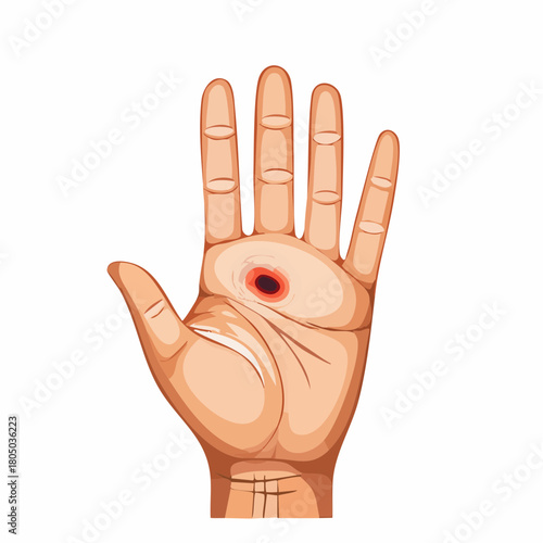 A small, deep puncture wound on the palm of the hand, showing a dark pinprick entry point.