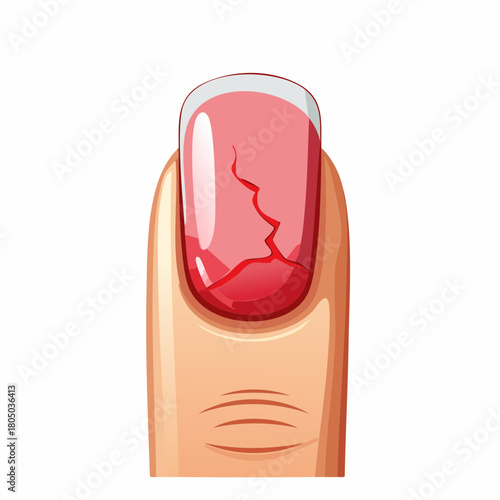 A fresh, bleeding split cuticle near the fingernail, showing a tiny red fissure at the skin margin.