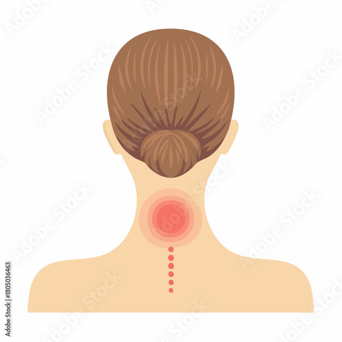 A pattern of localized pinched skin discoloration on the back of the neck, showing a reddish mark from pressure.
