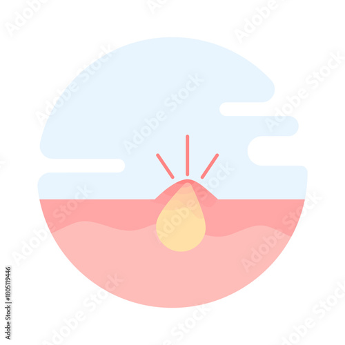 Acne and skin irritation concept showing clogged hair follicles, sebum buildup, swelling, pus, and symptoms related to allergies or eczema. flat design illustration on background.