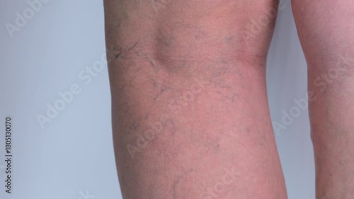 Varicose veins on the legs close up on a white background