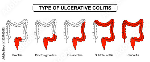 Illustration types of ulcerative colitis. Inflammation of the human digestive system. Inflammatory bowel disease, Inflammation of the human digestive system. Vector drawing illustration for medical