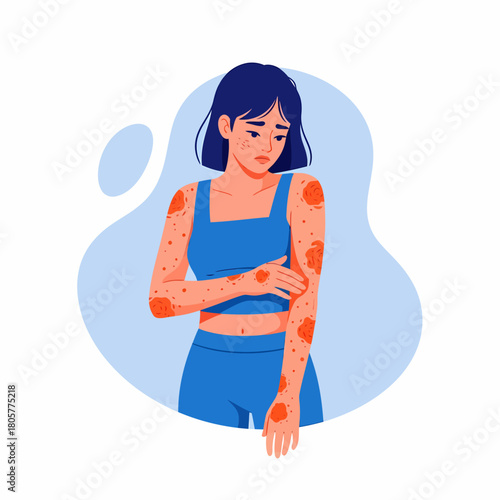 Woman Suffering from Skin Allergy, Eczema, or Dermatitis Rashes