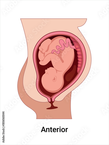 Anterior Baby Positions in the Uterus during Pregnancy. Pathology. Detailed Medical vector illustration. 
