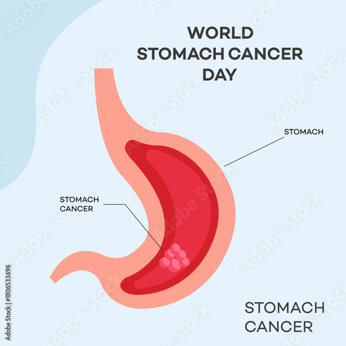 World Stomach Cancer Day Illustration  Medical Awareness Campaign