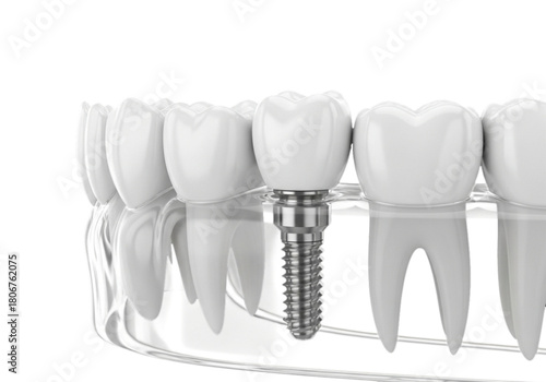 3D rendering of dental implant in jaw structure. cutout on transparent background