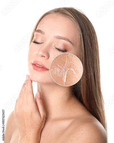 Canvas Print Zoomed in cheek area showing dry flaky skin