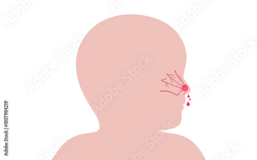 Nosebleed medical poster