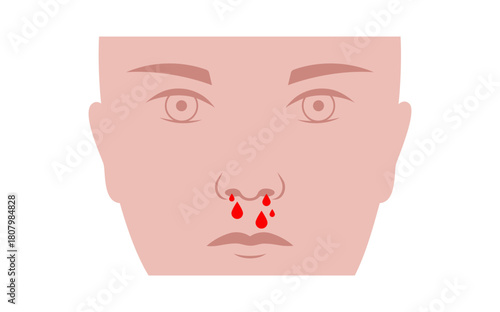 Nosebleed medical poster