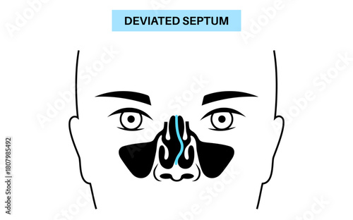 Deviated septum poster