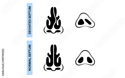 Deviated septum poster