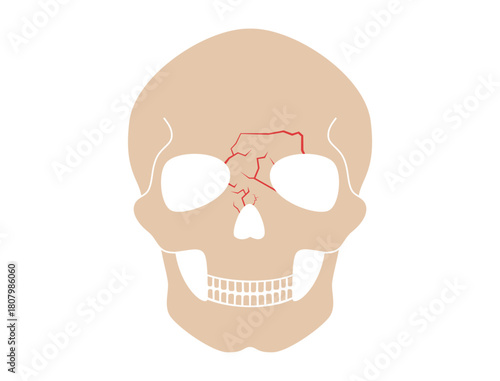 Nasal fracture poster