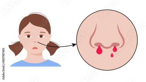 Nosebleed medical poster