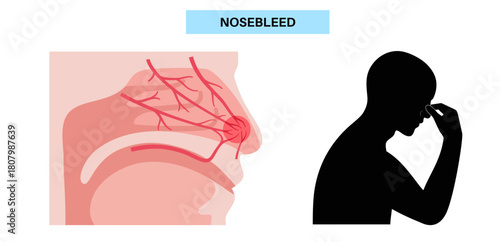 Stop nosebleed instruction