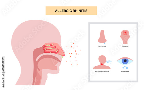 Allergic rhinitis poster