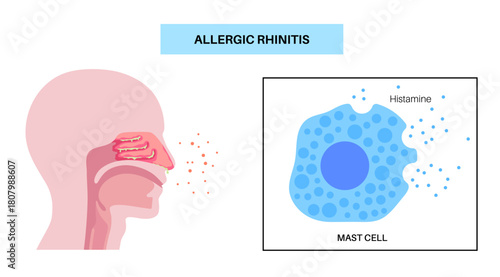 Allergic rhinitis poster