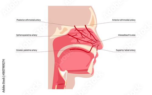 Nosebleed medical poster