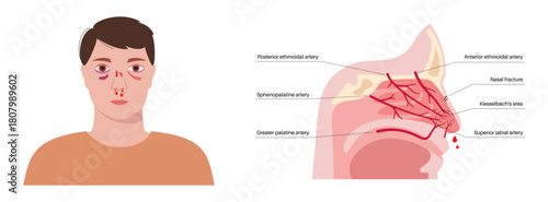 Nasal fracture poster