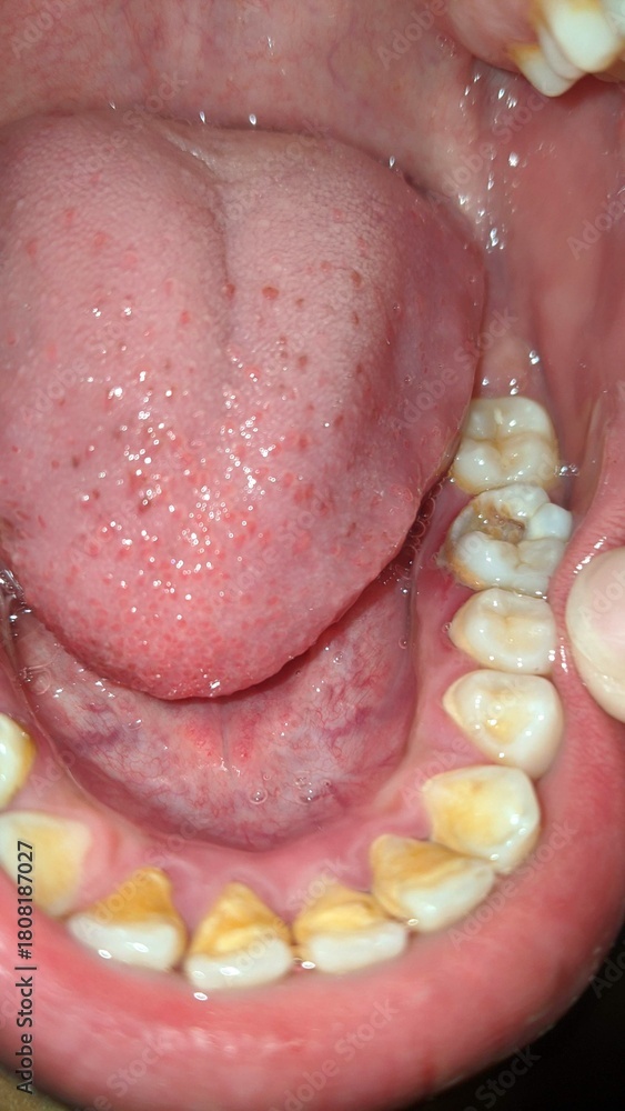 Obraz premium Close-up view of an open human mouth showing lower teeth with yellow staining and a molar with a visible cavity or old filling, alongside the tongue.