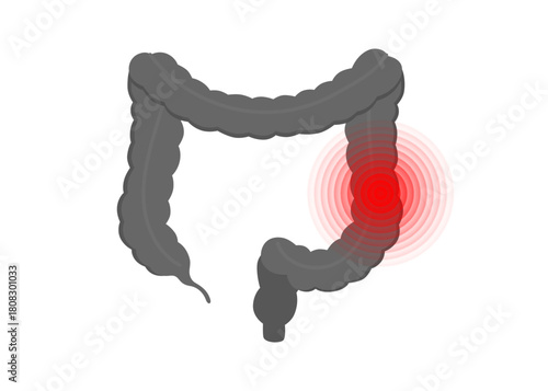 Colon polyps inflammation stock illustration