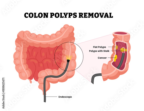 Colon polyps removal with endoscope, flat polyps and cancer with cross section part. Colonoscopy and polypectomy. Human large and small intestine. Medical healthcare flat illustration