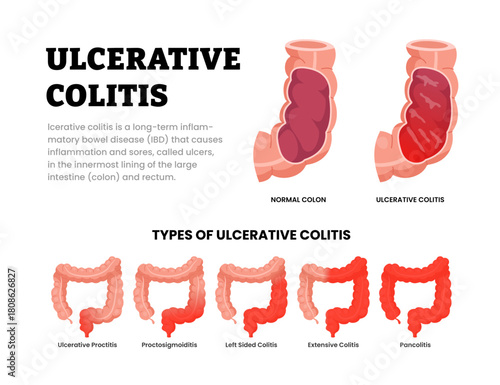 Different types of ulcerative colitis types. Labeled ulcerative proctitis, proctosigmoiditis, left sided colitis, extensive, pancolitis. Chronic inflammatory bowel disease. Lining colon and rectum.