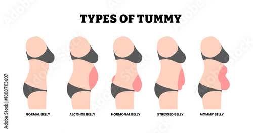 Different types of tummy types set collection. Labeled normal, alcohol, hormonal, stressed, mommy belly. Diastasis Recti six pack separation belly rectus for woman. Body Type. Medical science.