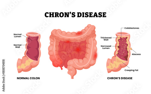 Crohn's disease with colon large intestine cross section view, thickened wall, narrowed lumen, abscess, creeping fat, cobblestones. Inflammatory bowel disease. Healthcare design poster illustration.