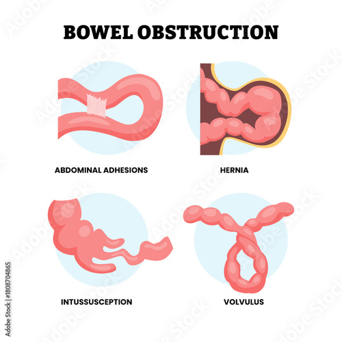 Different types of bowel obstruction types. Labeled abdominal adhesions, hernia, intussusception, volvulus. Blockage of your small or large intestine. Medical science educational illustration