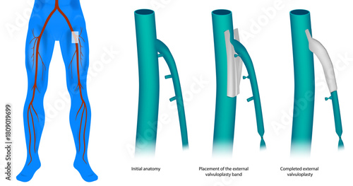 Medical illustration showing the steps of external valvuloplasty applied to the great saphenous vein at the saphenofemoral junction. Junction Repair with External Banding