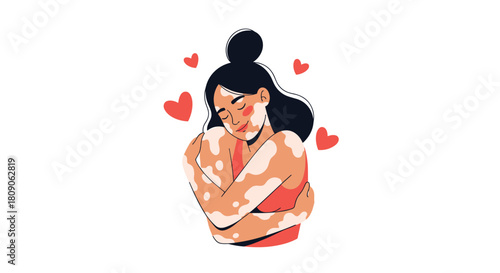 Beautiful woman with vitiligo skin condition smiling and hugging herself promoting self-love and body positivity.