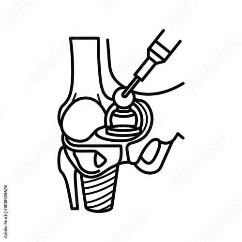Knee replacement surgery illustration depicting an artificial joint being implanted into the leg bone