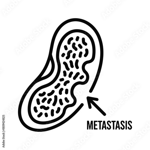 Metastasis in kidney isolated on, a secondary cancerous growth from a primary tumor site