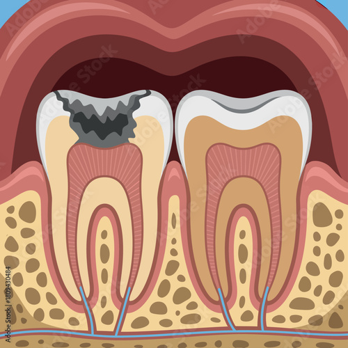 Close up illustration of healthy tooth next to decayed tooth with cavity