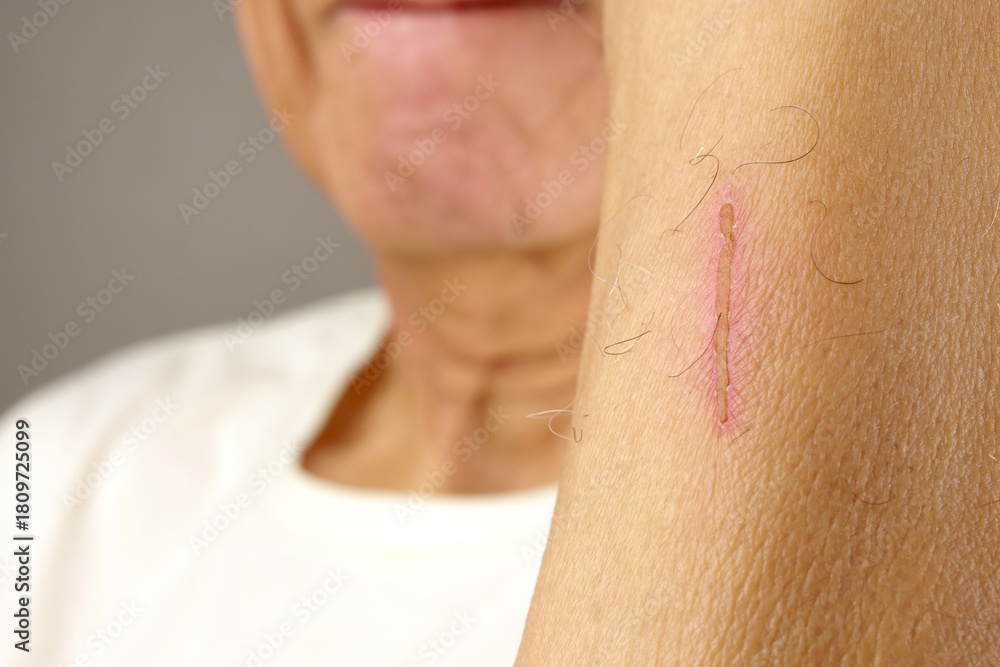 Naklejka premium Man with a scab on his arm caused by a scratch that’s healing