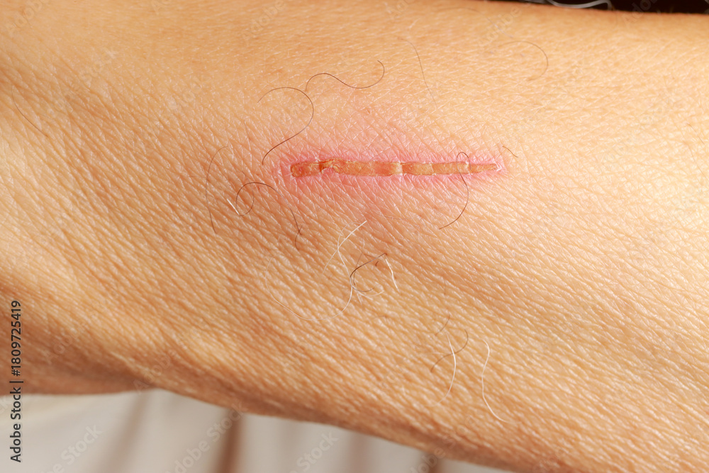 Fototapeta premium Man with a scab on his arm caused by a scratch that’s healing