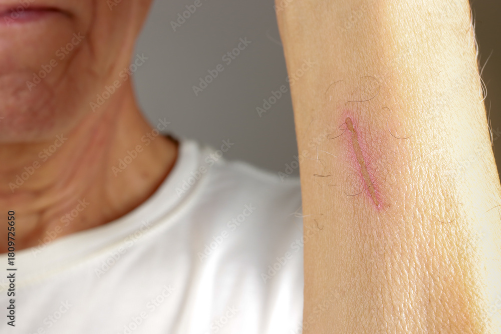 Fototapeta premium Man with a scab on his arm caused by a scratch that’s healing