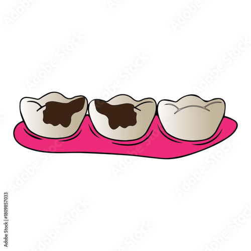 Teeth with cavities