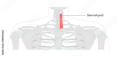 Sternothyroid - Infrahyoid muscle depicted in anatomy chart that depresses the thyroid cartilage, important for larynx movement and voice modulation, used in clinical and educational illustration