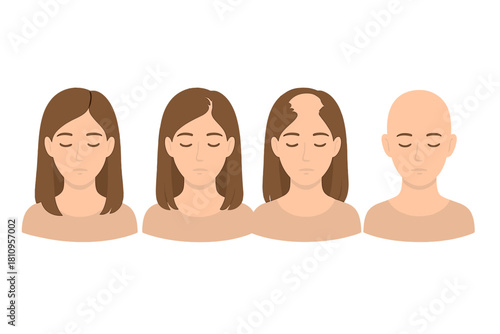 Stages of female hair loss progression showing different degrees of thinning and baldness