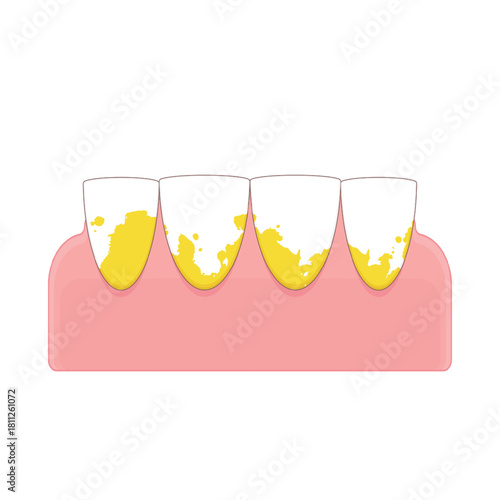 Lower front teeth on the gums with tartar and plaque cartoon cute