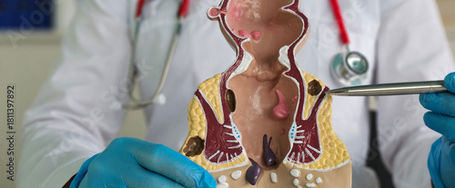 A doctor explains the anatomy of the rectum and anus using a model concept