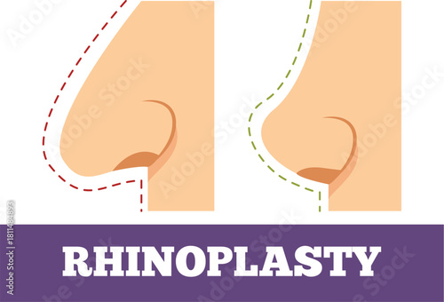 Rhinoplasty Nose Surgery Before and After Correction Vector Illustration