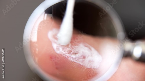 Obligatory medicine therapy during acute phase o dermatological diseases, patient applying steroid ointment on inflamed skin, healing of eczema, dyshidrosis or psoriasis with special symptoms relief