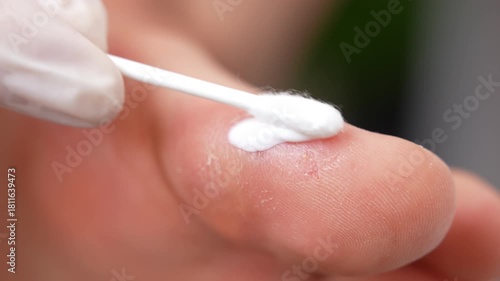 Serious dermatological disease of human body, inflamed toe skin with eczema, process of applying steroid ointment of irritated site for symptoms relief, patient's acute dyshidrosis on toe caused by