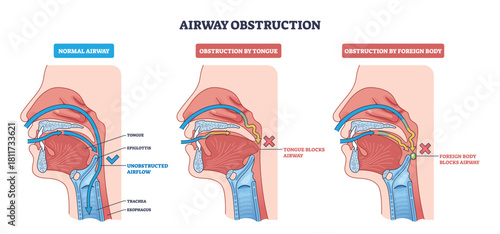 Airway obstruction diagram shows normal airflow vs blockage by tongue or foreign body, key parts, tongue, epiglottis, trachea. Outline diagram