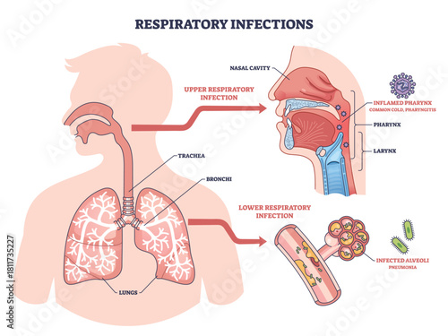 Respiratory infections brief outline shows upper and lower tract disease, highlighting lungs, pharynx, and alveoli in a clear medical infographic for education. Outline diagram