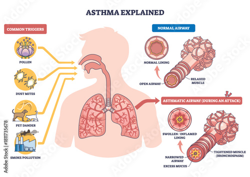 Asthma explained diagram shows lungs, bronchi, and triggers, contrast normal vs asthmatic airways showing inflammation, mucus, and tight muscles causing breathing trouble. Outline diagram